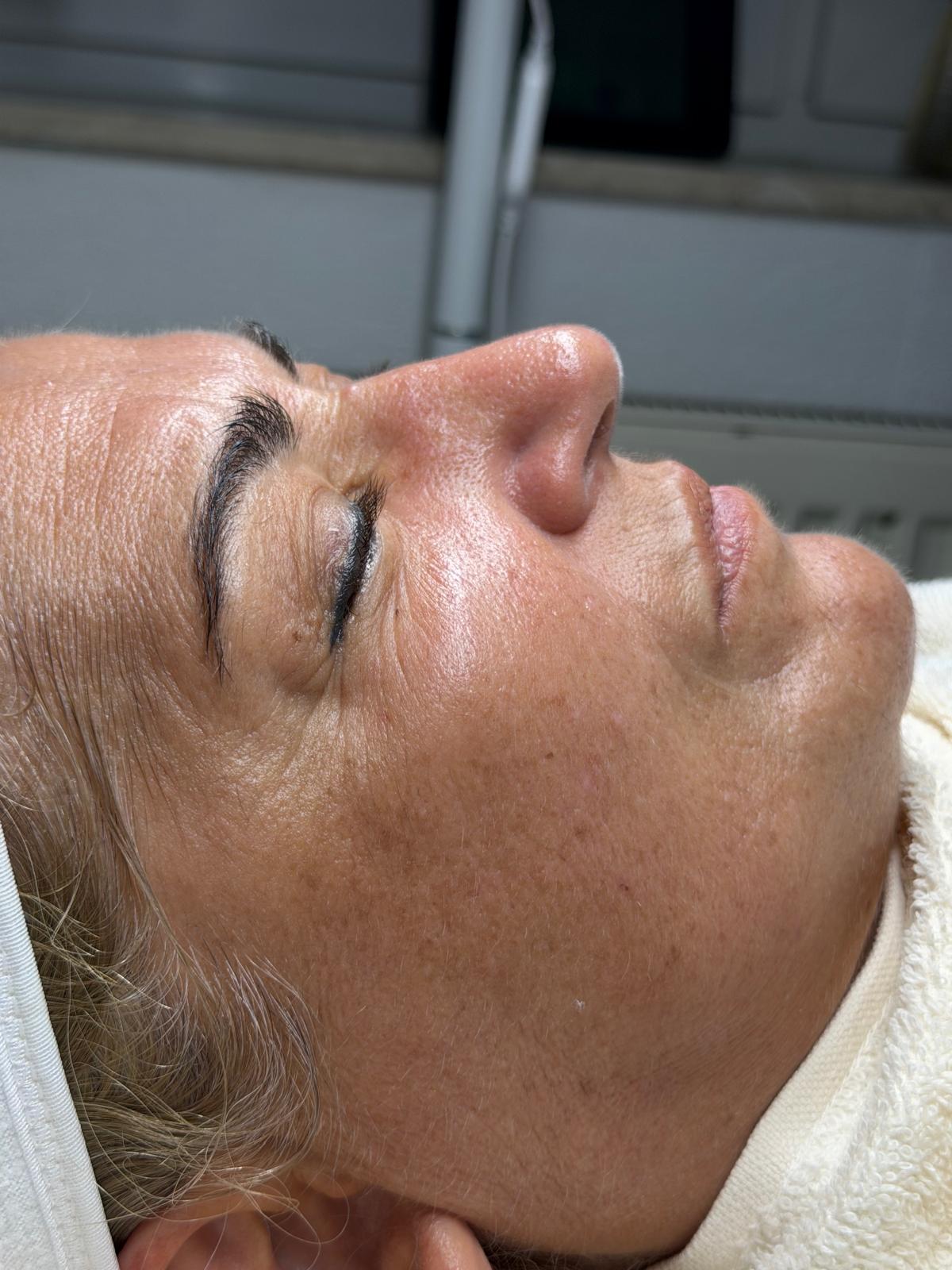 Aqua Facial + Microneedling – Nachher