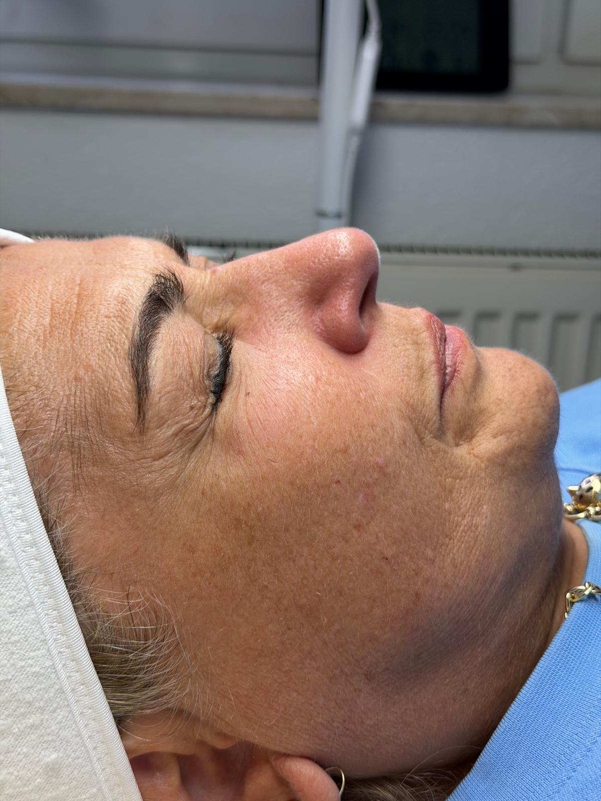 Aqua Facial + Microneedling – Vorher