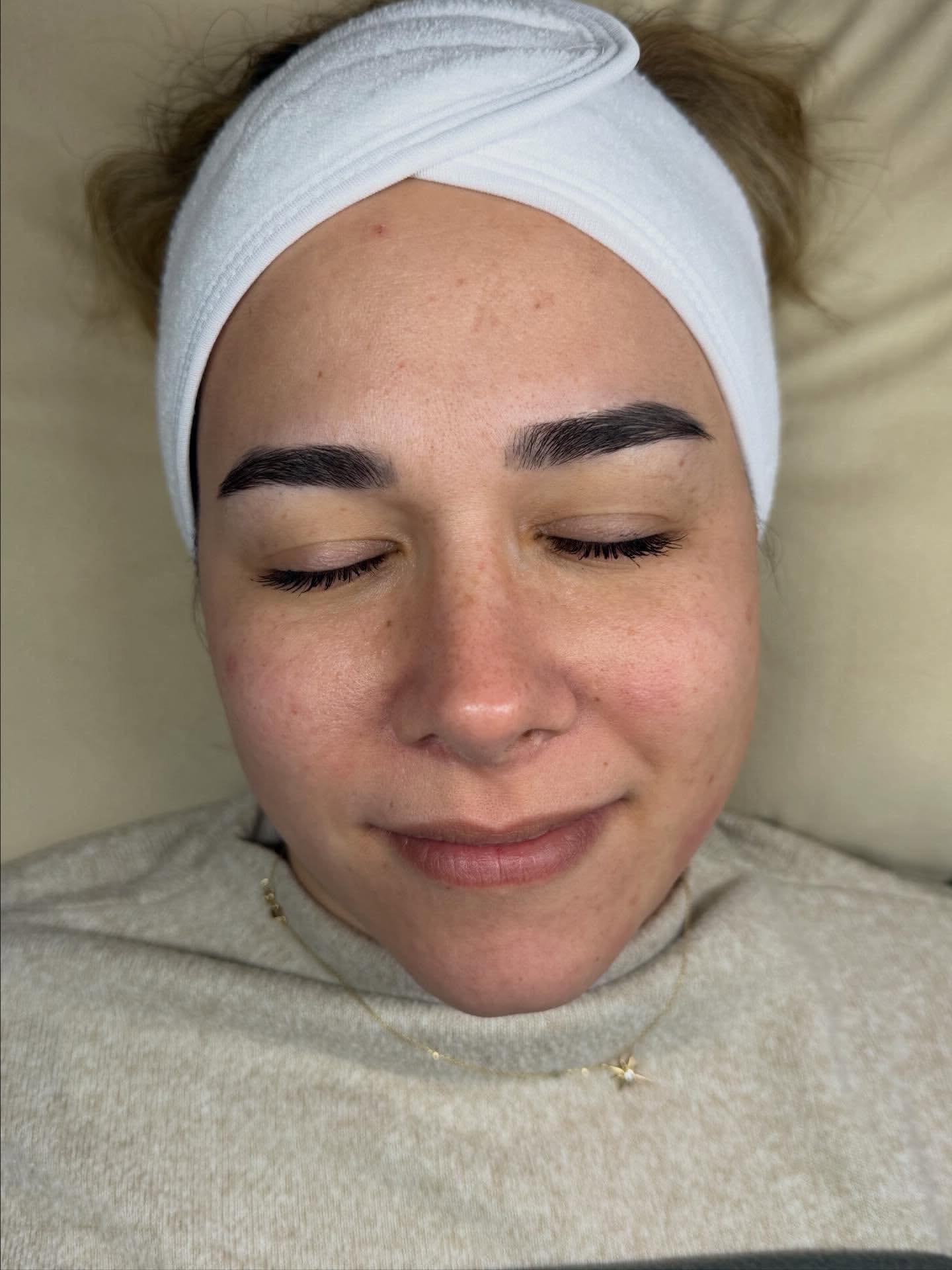 Microneedling · 1 Sitzung – Vorher